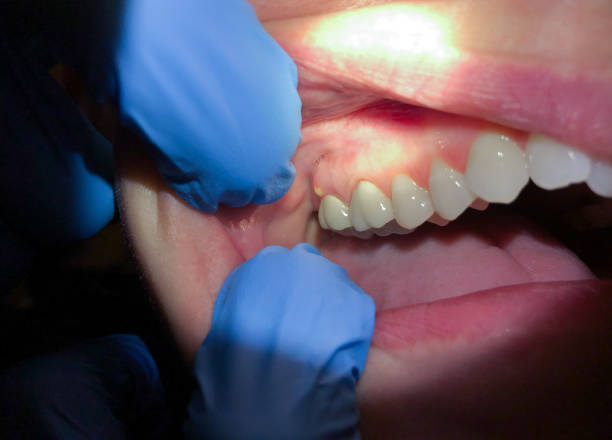 Best Broken Tooth Emergency  in Bard College, NY