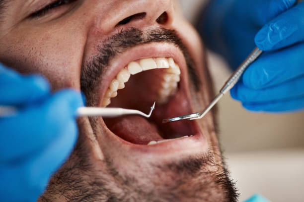 Best Chipped Tooth Repair Near Me  in Bard College, NY